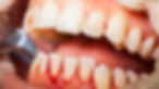 Bleeding Gums