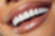 Teeth Whitening
