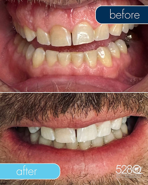 Before and after professional teeth whitening results at 5280 Teeth Whitening in Denver, CO