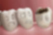 Cavities
